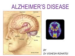 Inflammation Promotes the Progression of Alzheimer’s Disease
